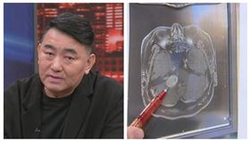 徐亨長腦瘤。（圖／翻攝自新聞挖挖哇YT）