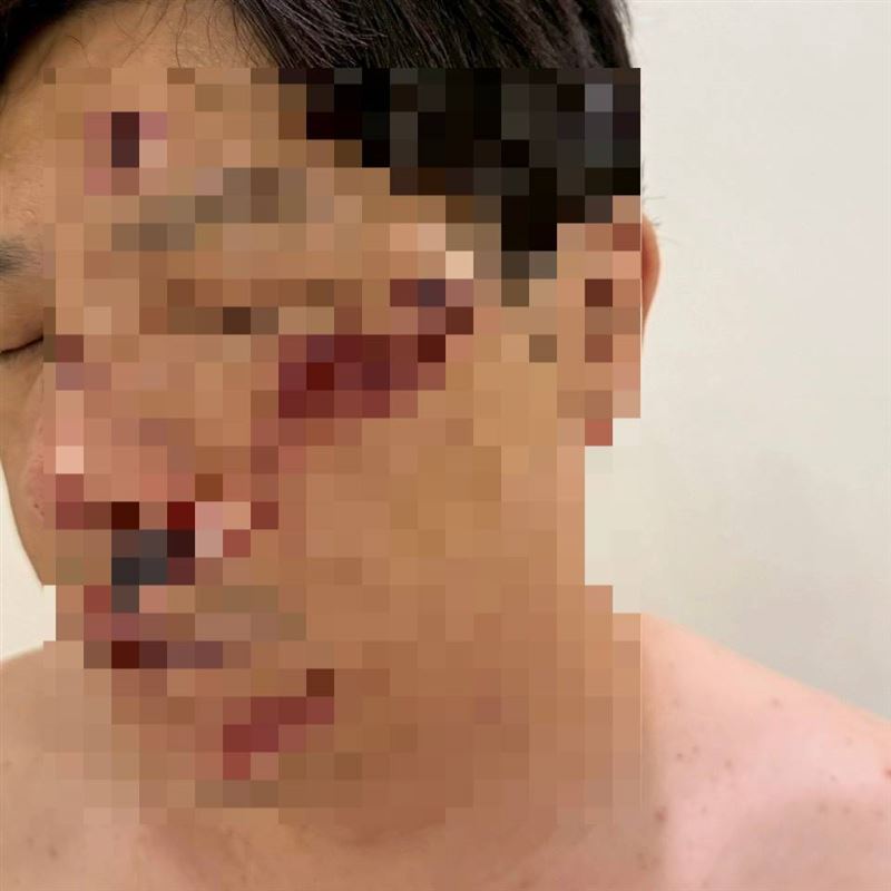 PAZZO董座廖承豪曝自己臉上的傷勢和驗傷單，對於做了不良示範致歉。（圖／翻攝畫面）