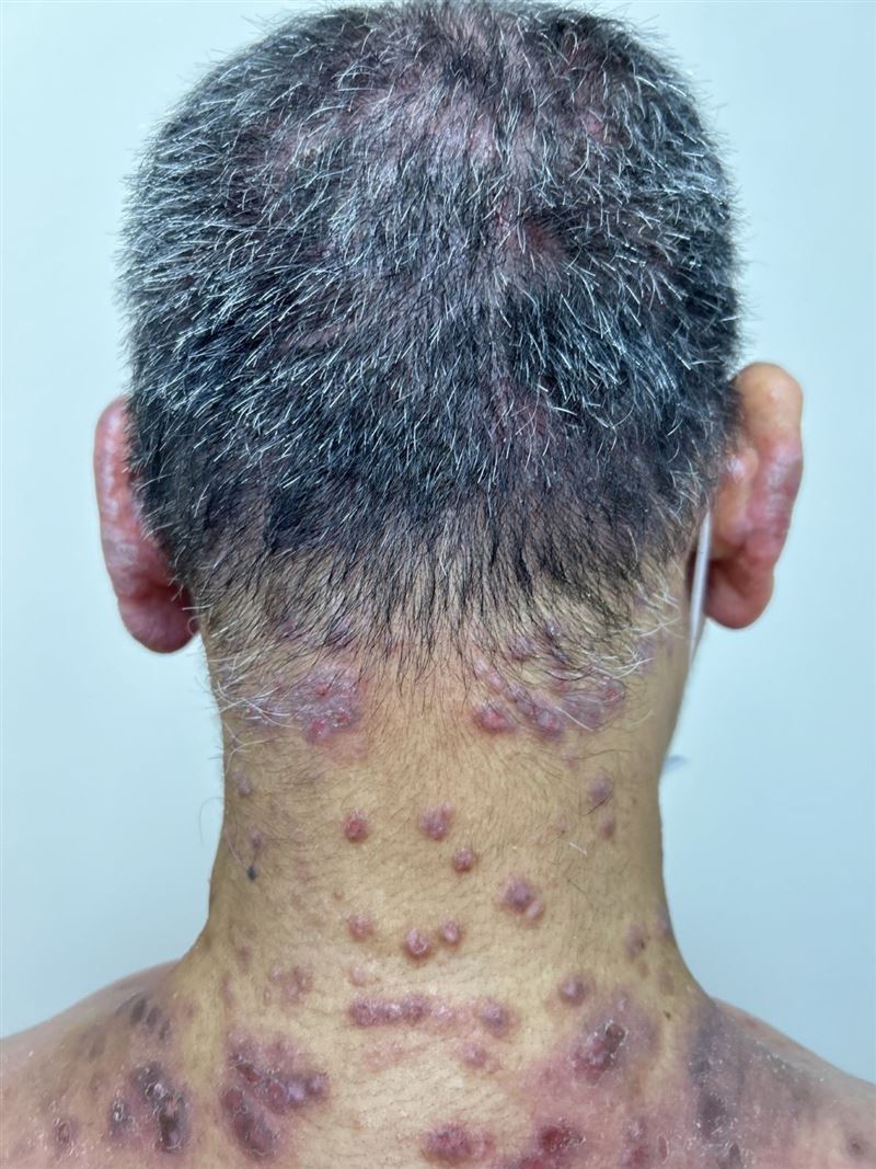 林先生長年受異位性皮膚炎所苦，全身遍布丘疹與結節性癢疹，皮膚乾裂潰爛。（圖／台北慈濟醫院提供）