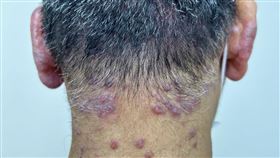 林先生長年受異位性皮膚炎所苦，全身遍布丘疹與結節性癢疹，皮膚乾裂潰爛。（圖／台北慈濟醫院提供）