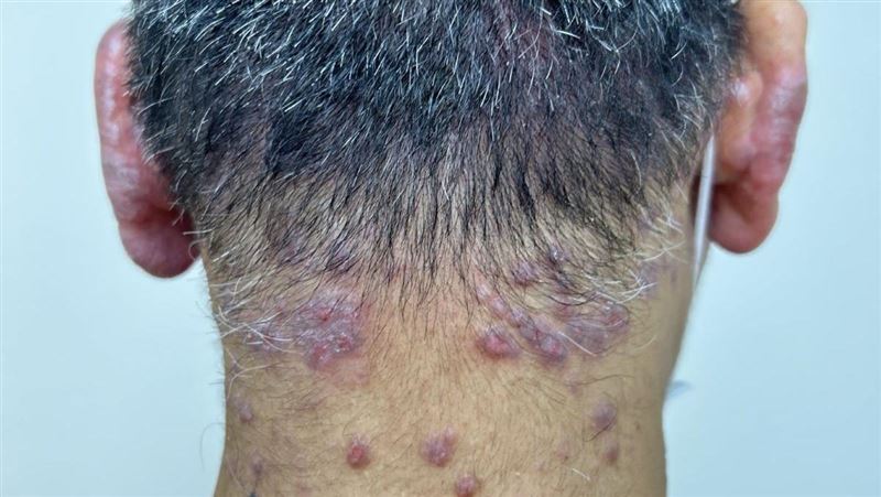 他癢到「遍體麟傷」！醫：25%成年後發病