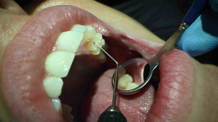 智齒要不要拔？牙醫師提供4關鍵一次解惑