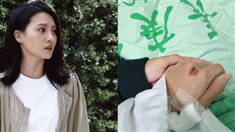 女星重傷住院！用酒精消毒痛到崩潰哭濕被