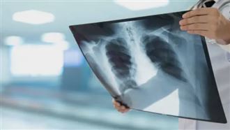 肺結核「死亡率達5成」　10大QA一文看懂