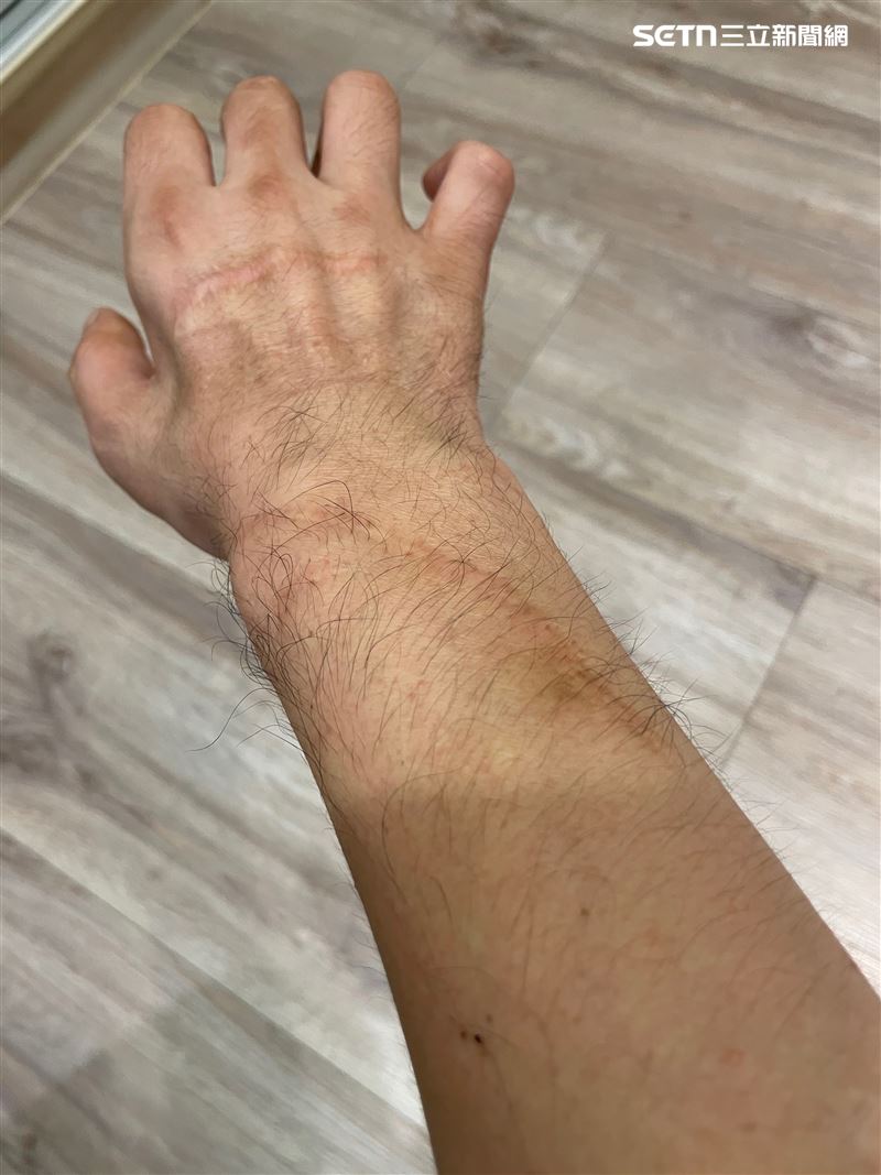 李姓男子3年前右手掌遭利刃重創，導致尺神經、正中神經與尺側動脈嚴重受損，導致五指癱軟。（圖／翻攝畫面）