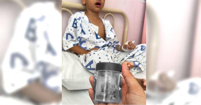 馬來西亞有一名男童從小喝奶就直接睡覺,沒有養成規律刷牙的好習慣,結果乳牙全蛀壞,近期一次被拔除12顆牙。(圖/翻攝自臉書/Siti Nur Haliza)