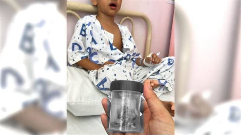 男童從小1壞習慣不改　一次被拔12顆牙齒