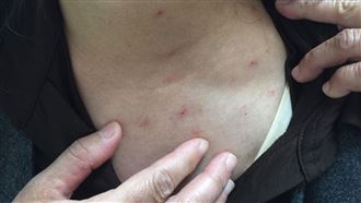 冬天成異膚炎穿衣地雷！醫：2材質是大忌