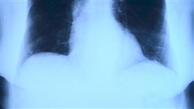 x光,肺部。（示意圖／PIXABAY）