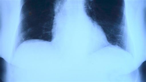 連咳5天當普通感冒！他照X光「左肺全白」