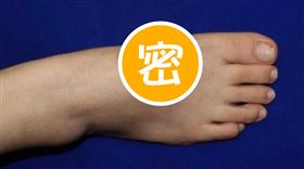 耳朵,工安意外,寄生,腳背（圖／翻攝自香港01）