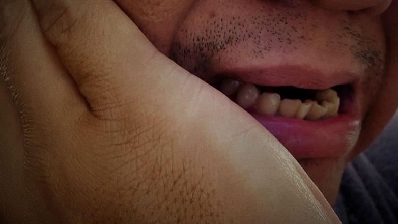 45歲林姓男子曾罹患帶狀疱疹,痊癒後卻突然出現臉頰刺痛,從刷牙、漱口到咀嚼,只要碰到臉部就會引發像被電擊般的「三叉神經痛」。(圖/資料庫)