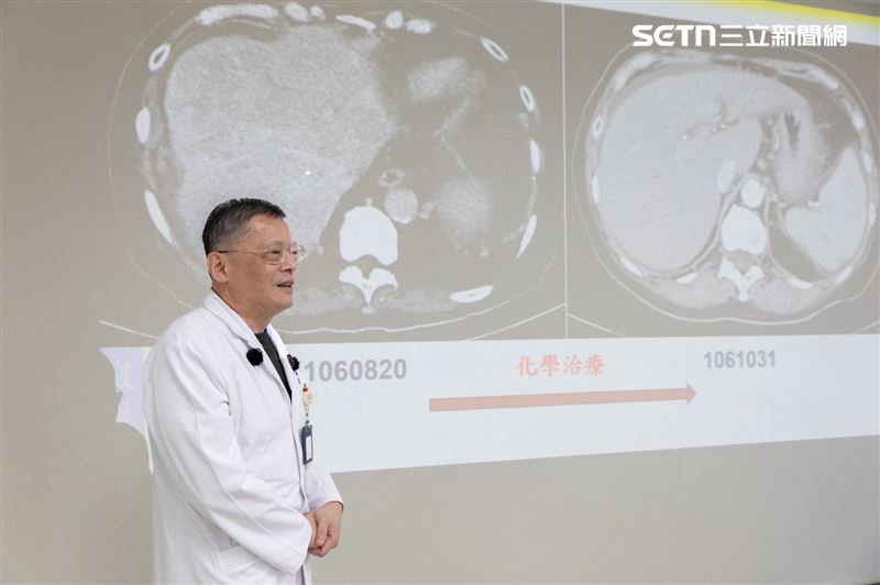 宋女士經過穩定追蹤後，目前都無復發狀態。（圖／陽明交大醫院提供）
