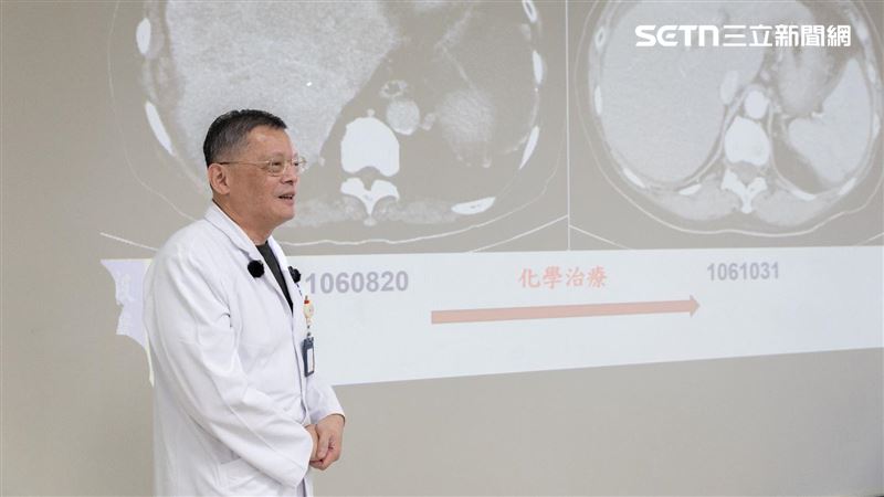 肝癌婦數百顆腫瘤　 醫院化療全創消奇蹟