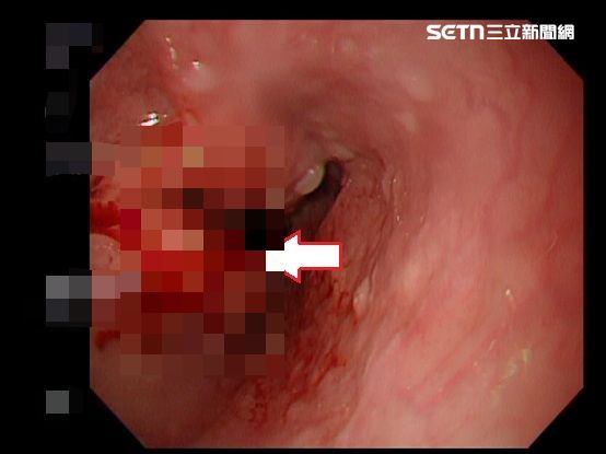 連喝水都吞不下去,胸口像被異物堵住,才驚覺就醫檢查,結果已是下段食道癌第三期合併淋巴轉移。(圖/亞大醫院提供)
