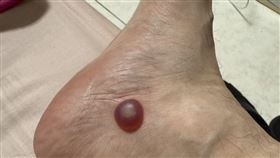 男子腳長出一個1元硬幣大小的異物。(圖／資料照)