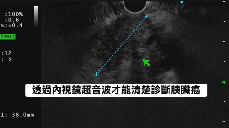 她半年瘦10公斤竟罹癌王　3大症狀別輕忽