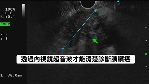 她半年瘦10公斤竟罹癌王　3大症狀別輕忽
