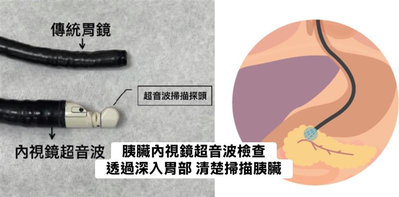 林相宏表示，要透過胰臟內視鏡超音波才可以清楚檢查到胰臟。（圖／翻攝自林相宏臉書）