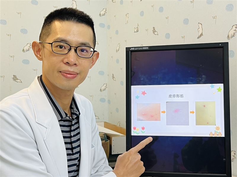 蘇軏醫師表示,水痘的症狀會從頭皮、臉、軀幹開始出現皮疹,然後向四肢蔓延。(圖/書田診所提供)