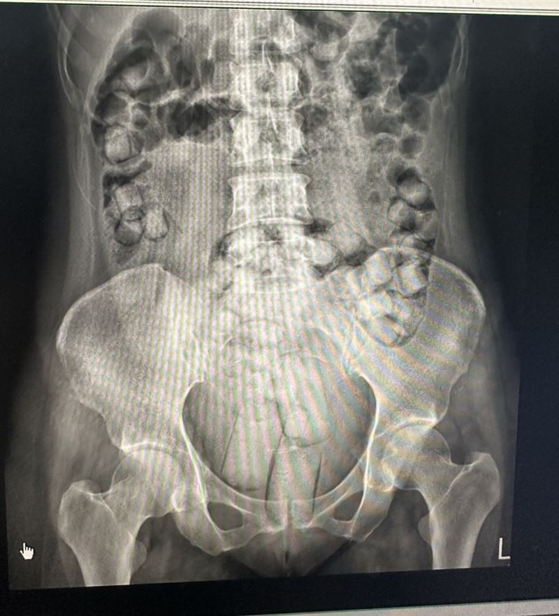 兩名泰國女子狂吞115顆海洛因膠囊，腸胃道全塞滿滿。(圖／翻攝畫面)