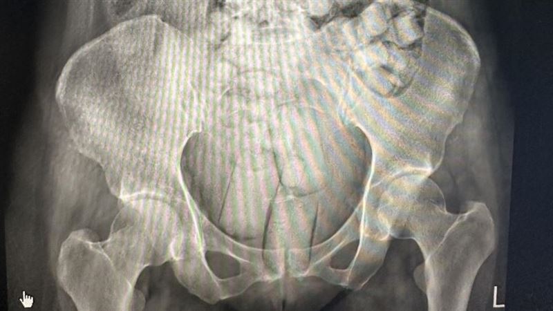 腸胃塞滿毒！2泰女「人體運毒」冒險搭機