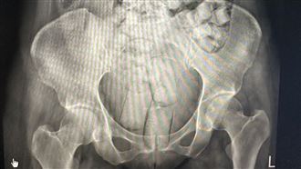 腸胃塞滿毒！2泰女「人體運毒」冒險搭機