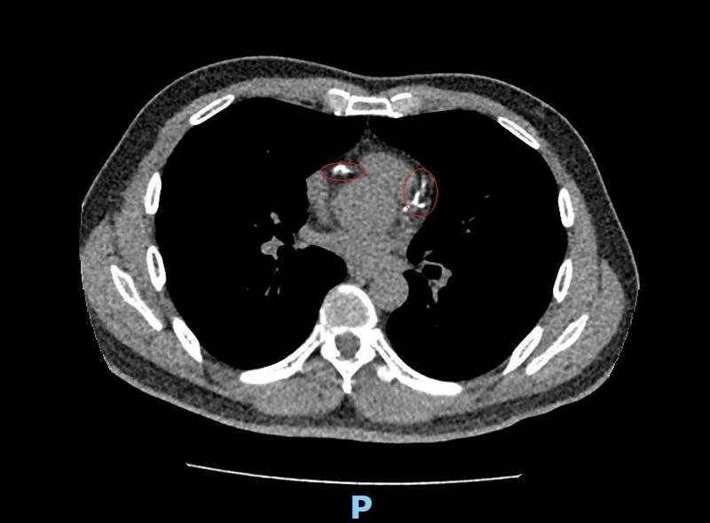 49歲男做肺癌篩檢意外發現心血管鈣化,冠狀動脈阻塞達85至100%。(圖/彰化醫院提供)