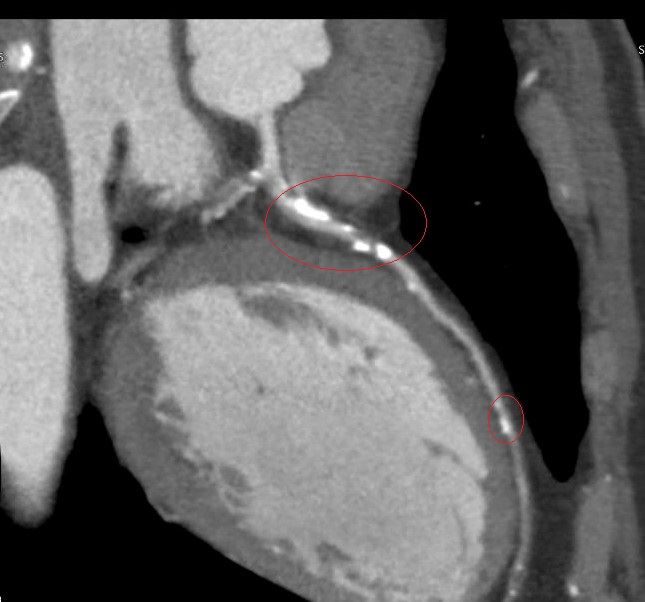 林姓男子進行心臟冠狀動脈電腦斷層,顯示冠狀動脈已鈣化阻塞。(圖/彰化醫院提供)