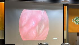 醫師檢查發現黃小姐罹罕見「咽喉小唾腺惡性腫瘤」，大小如同「鴿子蛋」。（圖／記者簡浩正攝影）