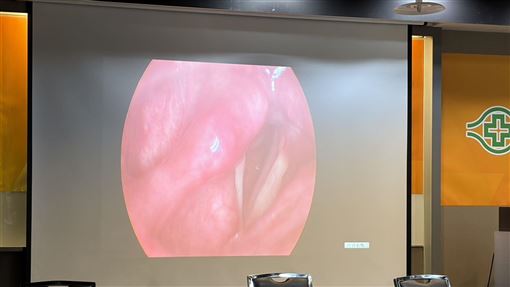 睡覺鼾聲變大竟是「3期癌」46歲婦險失聲