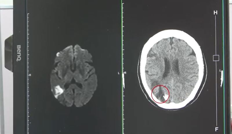 60多歲婦人從事裁縫工作,視力突然模糊,檢查後竟是非典型中風,右邊中大腦動脈阻塞 。(圖/大甲李綜合醫院提供)