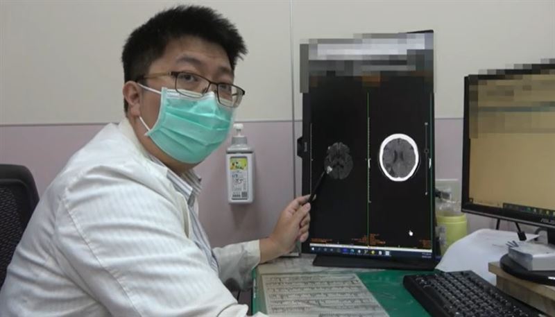 婦人渾然不知自己中風,因阻塞範圍變大,壓迫到變成左手變麻才就醫。(圖/大甲李綜合醫院提供)