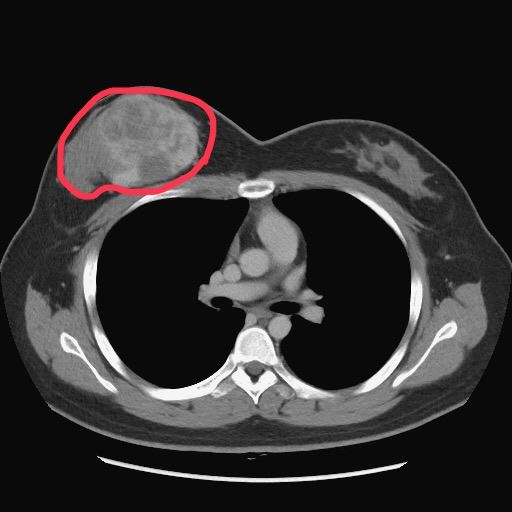 25歲陳小姐的右乳房長出葉狀瘤,2週時間迅速成長大了一個罩杯。(圖/台中榮總醫院提供)