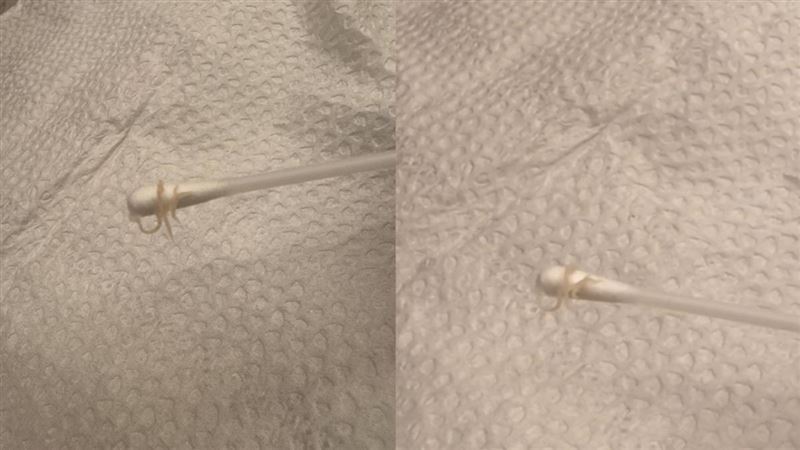 女兒狂喊屁股癢!母擦藥驚見肛門蟯蟲蠕動