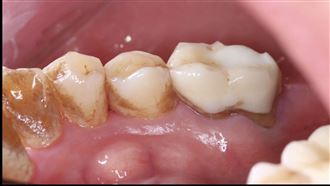 35歲民眾9成有牙周病變！醫曝「7大警訊」