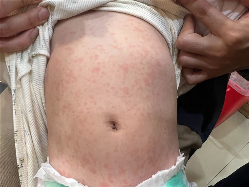 腸病毒仍處流行期,兒科醫師收治病童出現手足口病與咽峽炎,更有嬰兒就診時「全身滿是病毒診」。(圖/施勝桓醫師提供)