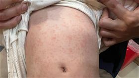 腸病毒仍處流行期，兒科醫師收治病童出現手足口病與咽峽炎，更有嬰兒就診時「全身滿是病毒診」。（圖／施勝桓醫師提供）