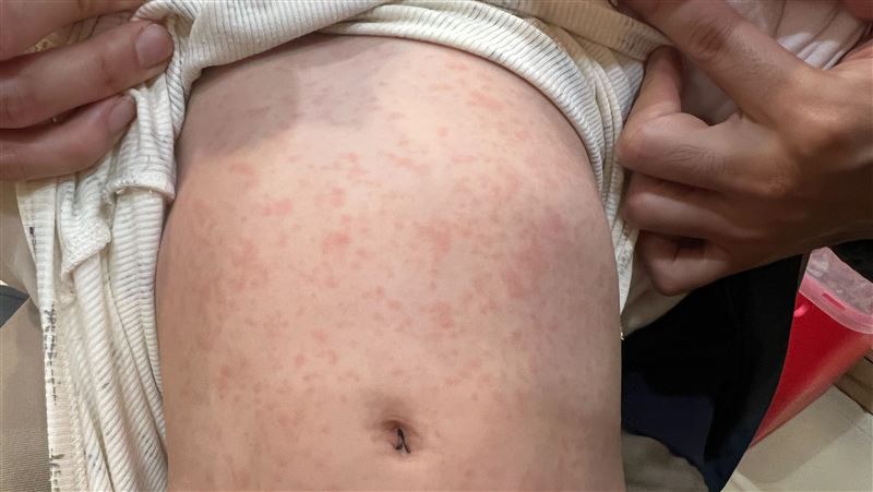 獨/嬰就診竟「全身疹」醫憂1病毒蠢蠢欲動