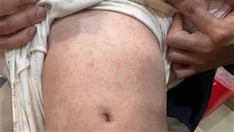獨/嬰就診竟「全身疹」醫憂1病毒蠢蠢欲動
