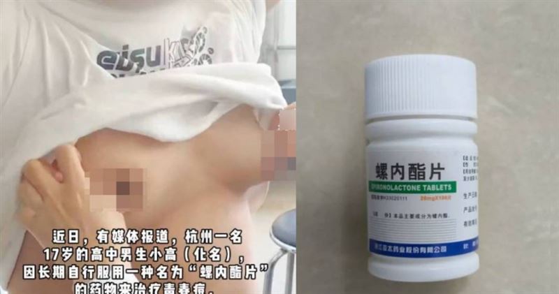 中國杭州有一名17歲少年為了治療青春痘自行服藥,導致乳房異常隆起。(圖/翻攝自微博@南方都市報)