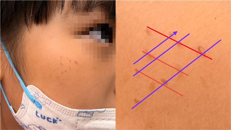 女童臉上「一整排紅疹」 醫曝1物惹的禍