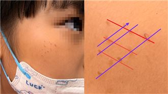 女童臉上「一整排紅疹」　醫曝1物惹的禍