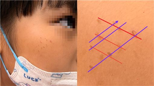 女童臉上「一整排紅疹」　醫曝1物惹的禍