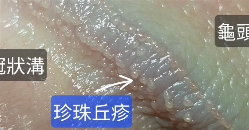 蘇信豪說明,「陰莖珍珠丘疹」是良性的,對人體無害。(圖/翻攝自蘇信豪臉書)