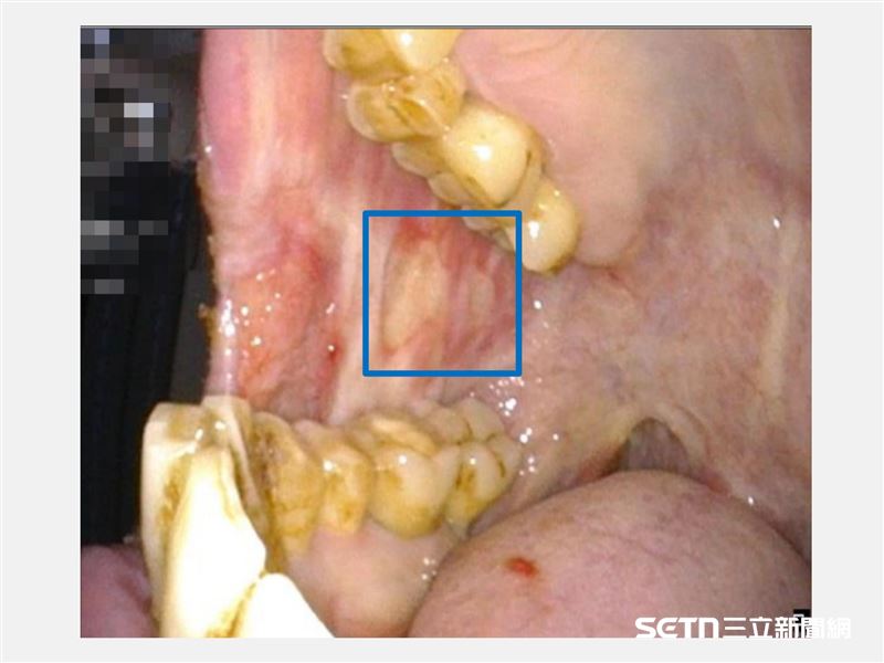 方框處即為口腔癌病灶。口腔癌初期難以察覺,導致半數以上的患者確診時已是晚期,不僅大幅降低治癒率,也使得治療更具侵入性,嚴重影響患者的口腔功能與容貌。醫師指出,口腔癌初期病灶極具「偽裝性」,常以無痛感的白斑、紅斑,或是兩週以上不癒合的潰瘍呈現,讓患者誤認為是單純的「嘴破」或「火氣大」而忽略,加上好發部位隱蔽,使得早期發現難度大增。(圖/院方提供)