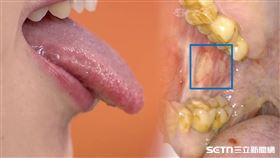 口腔癌／院方提供