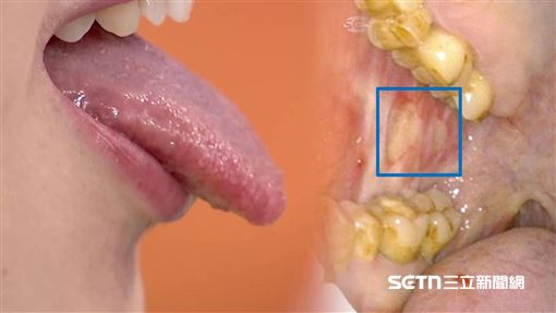 口腔癌專殺中壯年　3偽裝術騙倒大半患者
