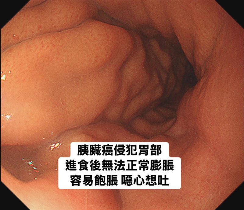 醫師林相宏表示，當胰臟癌的癌細胞蔓延到胃部，胃被壓迫失去彈性、無法膨脹，此時的患者吃一點就會想吐。（圖／取自林相宏醫師的臉書）