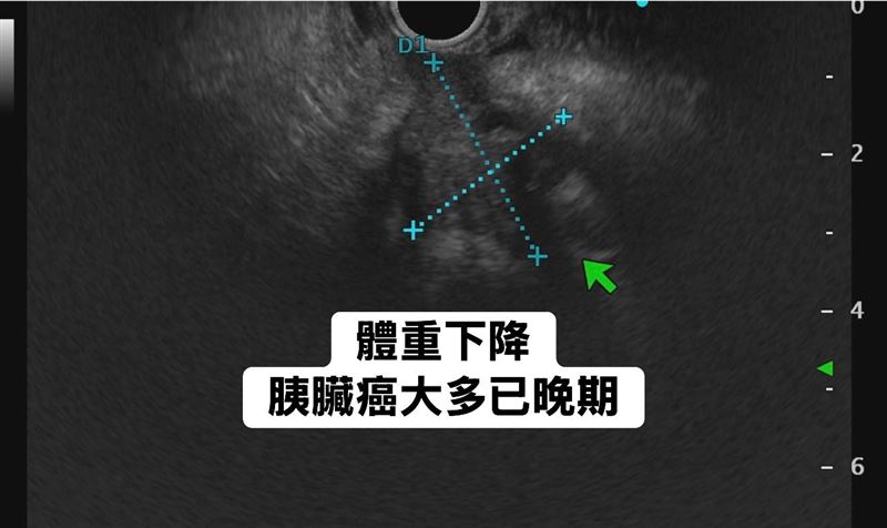 一名男子最近一個月起覺得噁心，體重驟降4公斤，就診林相宏才發現，已是第四期胰臟癌。（圖／取自林相宏醫師的臉書）